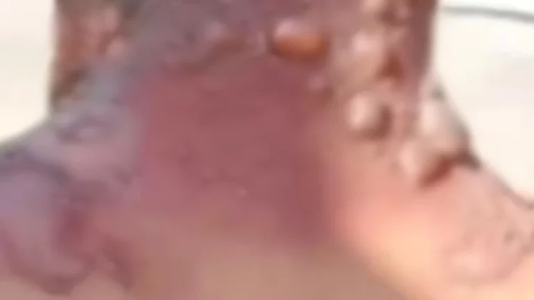 Mulher grávida acusada de cárcere e agressões queimando namorado com água fervente e deixando sequelas